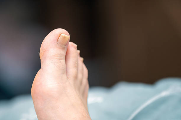 Big Toe Falling Off in a Dream